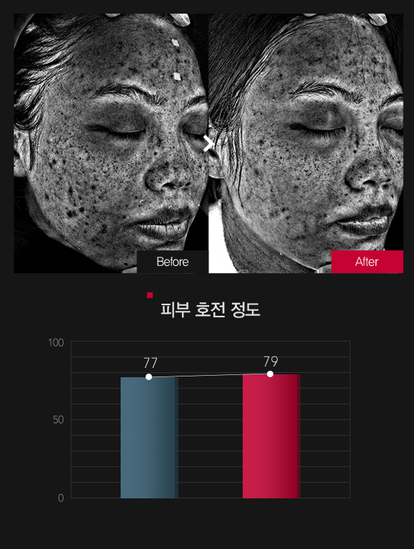 기미 & 멜라닌 색소지분포