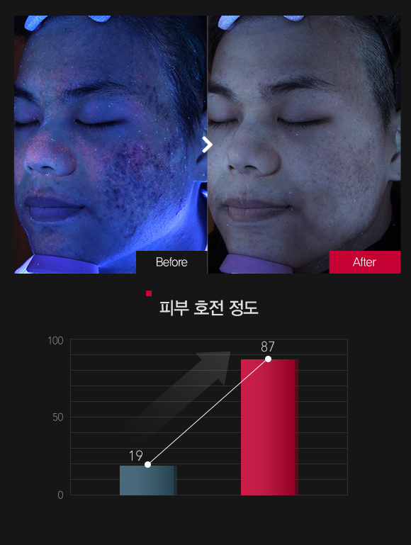 피지분포 호전정도