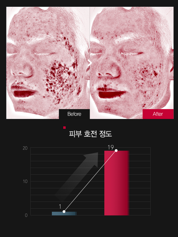 붉은기 & 피부민감도