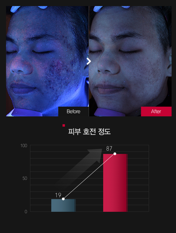 피지분포 호전정도