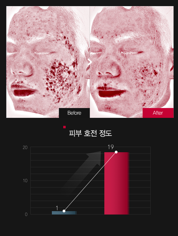 붉은기 & 피부민감도 호전정도