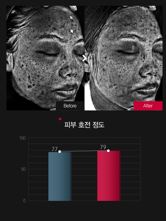 기미 & 멜라닌 색소 호전정도