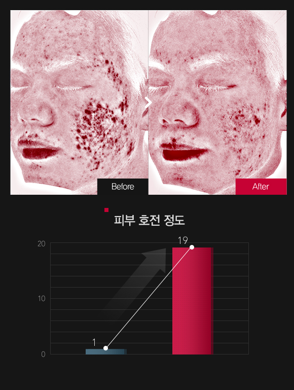 붉은기 & 피부 민감도