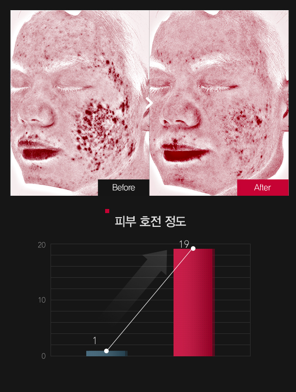 붉은기 & 피부 민감도 호전정도